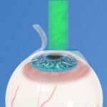 Grafik zur Vorgehensweise bei Augen Lasern durch Lasik
